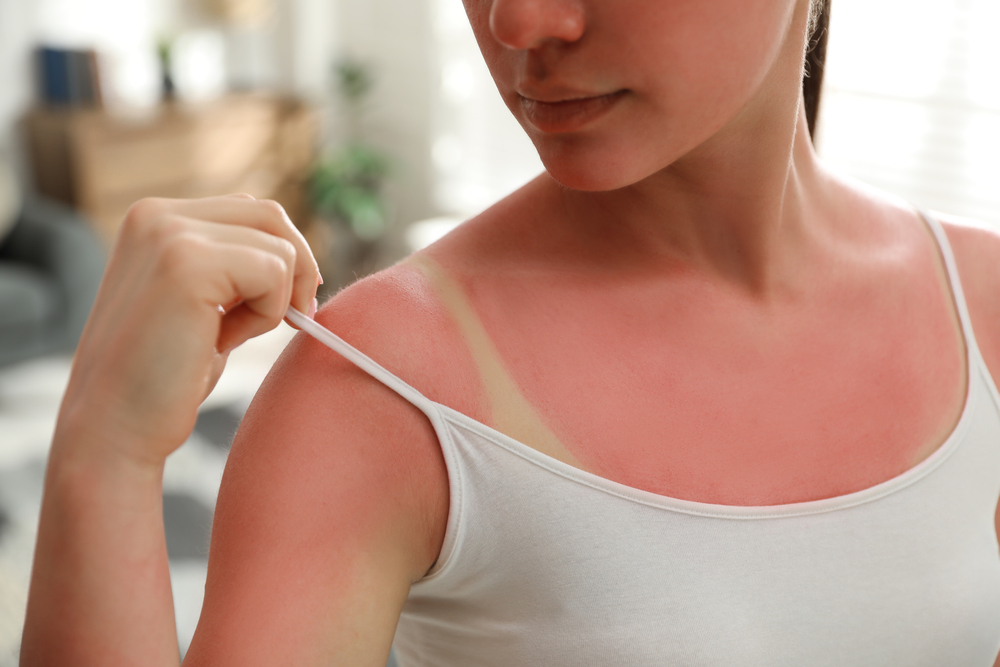 Sonnenbrand Nat Rlich Behandeln Tipps Zur Linderung Von Schmerzen Und